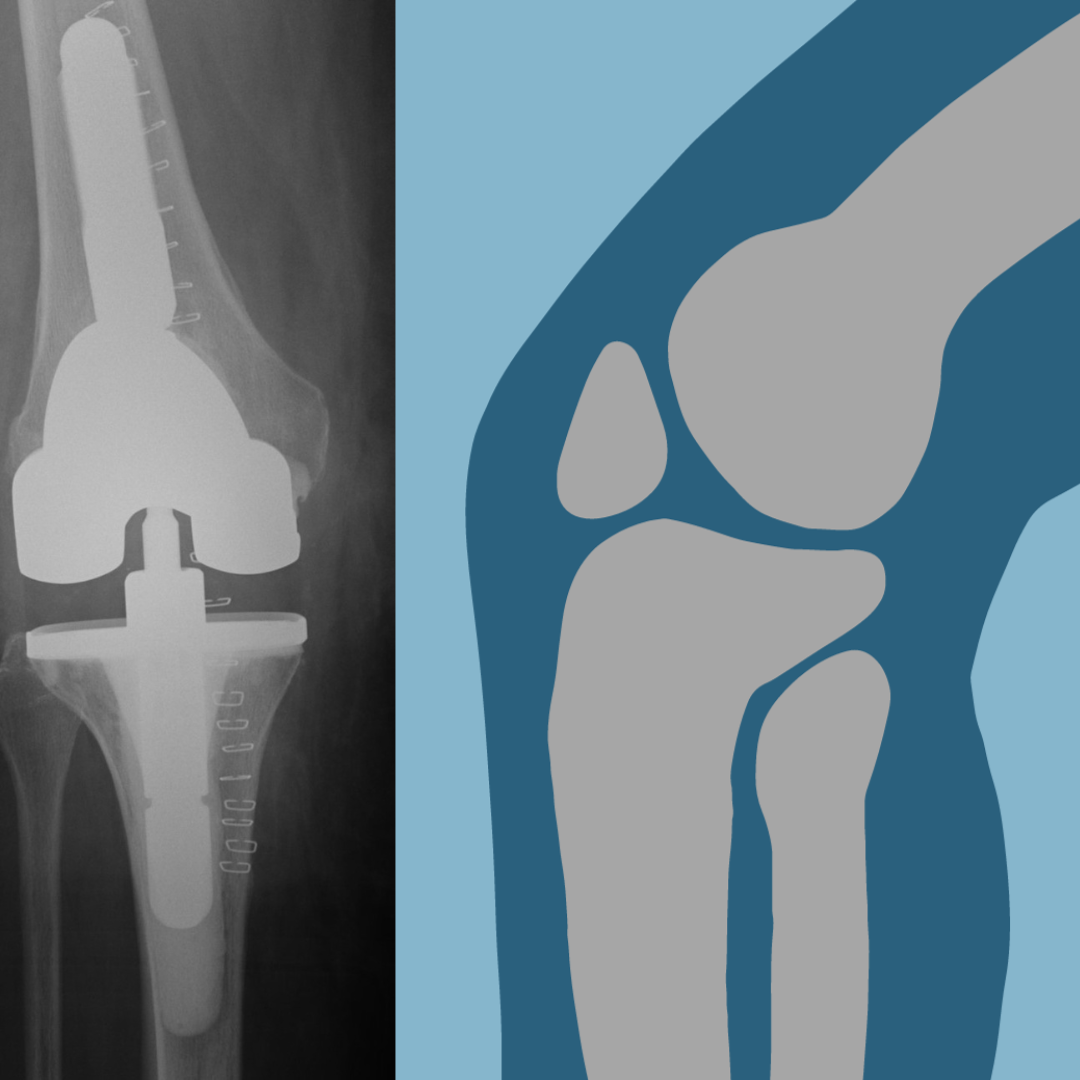 The benefits of early mobilisation post total knee replacement